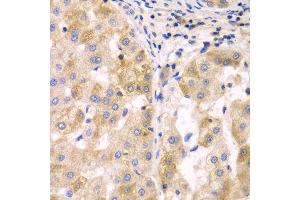 Immunohistochemistry of paraffin-embedded human liver cancer using SULT2B1 antibody. (SULT2B1 Antikörper  (AA 1-365))