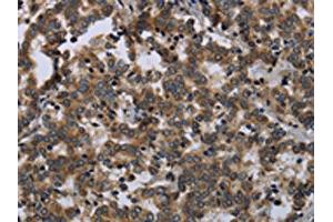 The image on the left is immunohistochemistry of paraffin-embedded Human liver cancer tissue using ABIN7129488(FGF18 Antibody) at dilution 1/20, on the right is treated with fusion protein. (FGF18 Antikörper)