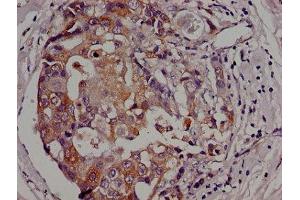 Immunohistochemistry of paraffin-embedded human breast cancer using ABIN7154605 at dilution of 1:100 (Adenylate Kinase 3 Antikörper  (AA 142-227))