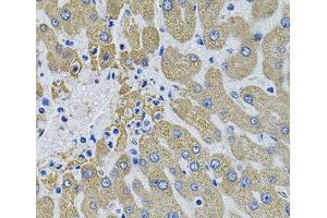 Immunohistochemistry of paraffin-embedded Human liver damage using MBL2 Polyclonal Antibody (MBL2 Antikörper)