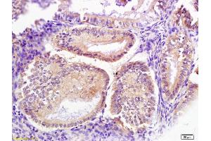 Formalin-fixed and paraffin embedded human endometrium carcinoma labeled with Anti-Signal recognition particle Polyclonal Antibody, Unconjugated (ABIN680228) at 1:200 followed by conjugation to the secondary antibody (Signal Recognition Particle (AA 401-500) Antikörper)