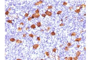 Formalin-fixed, paraffin-embedded human Hodgkin's Lymphoma stained with CD30 Rabbit Polyclonal Antibody. (TNFRSF8 Antikörper)