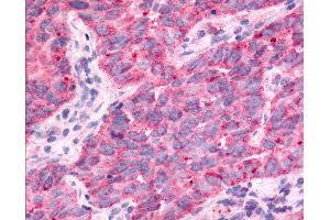 Anti-TAOK1 / TAO1 antibody IHC of human Lung, Non-Small Cell Carcinoma.