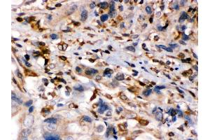Anti- TAP1 Picoband antibody, IHC(P) IHC(P): Human Intestinal Cancer Tissue (TAP1 Antikörper  (Middle Region))