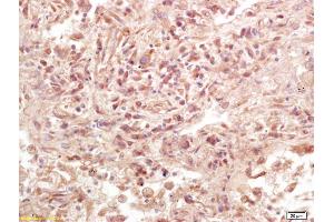 Formalin-fixed and paraffin embedded human lung carcinoma labeled with Anti-Phospho-LAT (Tyr161) Polyclonal Antibody, Unconjugated (ABIN1386362) at 1:200 followed by conjugation to the secondary antibody and DAB staining. (LAT Antikörper  (pTyr161))