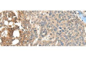 Immunohistochemistry of paraffin-embedded Human liver cancer tissue using MAPK4 Polyclonal Antibody at dilution of 1:35(x200) (MAPK4 Antikörper)