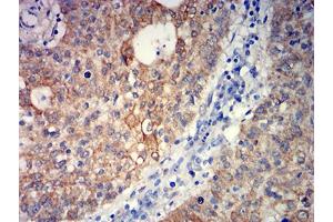 Immunohistochemical analysis of paraffin-embedded stomach cancer tissues using GRM5 mouse mAb with DAB staining.