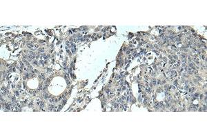 Immunohistochemistry of paraffin-embedded Human colorectal cancer tissue using SLC35F6 Polyclonal Antibody at dilution of 1:95(x200) (SLC35F6 Antikörper)