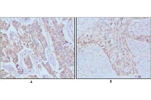Immunohistochemical analysis of paraffin-embedded human breast cancer,Lung breast tissues using EGF antibody (EGF Antikörper)