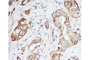IHC-P: IGF-1 antibody testing of human breast cancer tissue (IGF1 Antikörper  (Middle Region))