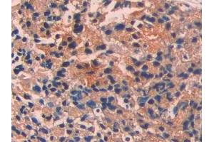 DAB staining on IHC-P; Samples: Human Prostate cancer Tissue (ECT2 Antikörper  (AA 453-647))