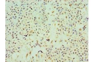 Immunohistochemistry of paraffin-embedded human breast cancer using ABIN7172211 at dilution of 1:100 (TFPI2 Antikörper  (AA 23-235))