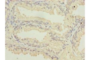 Immunohistochemistry of paraffin-embedded human prostate cancer using ABIN7144813 at dilution of 1:100 (ATL2 Antikörper  (AA 1-300))