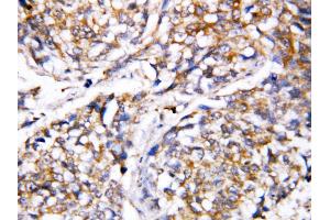 Anti-Caspase 4 antibody, IHC(P) IHC(P): Human Mammary Cancer Tissue (Caspase 4 Antikörper  (N-Term))