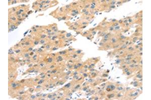 The image on the left is immunohistochemistry of paraffin-embedded Human liver cancer tissue using ABIN7192841(TNK1 Antibody) at dilution 1/20, on the right is treated with synthetic peptide. (TNK1 Antikörper)