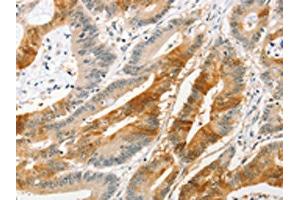 The image on the left is immunohistochemistry of paraffin-embedded Human colon cancer tissue using ABIN7128400(ANAPC2 Antibody) at dilution 1/20, on the right is treated with fusion protein. (ANAPC2 Antikörper)