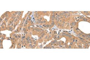 Immunohistochemistry of paraffin-embedded Human thyroid cancer tissue using PPP3R1 Polyclonal Antibody at dilution of 1:55(x200) (PPP3R1 Antikörper)