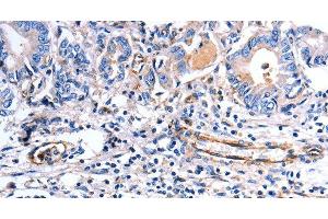 Immunohistochemistry of paraffin-embedded Human stomach cancer using COX11 Polyclonal Antibody at dilution of 1:30 (COX11 Antikörper)