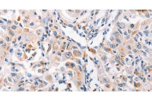 Immunohistochemistry of paraffin-embedded Human liver cancer tissue using MUC2 Polyclonal Antibody at dilution 1:60