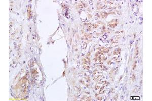 Formalin-fixed and paraffin embedded human cervical carcinoma labeled with Anti-phospho-GADD153 (Ser30) Polyclonal Antibody, Unconjugated (ABIN755977) at 1:200 followed by conjugation to the secondary antibody and DAB staining (DDIT3 Antikörper  (pSer30))