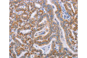Immunohistochemistry of Human cervical cancer using BST1 Polyclonal Antibody at dilution of 1:50 (BST1 Antikörper)