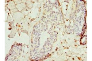 Immunohistochemistry of paraffin-embedded human breast cancer using ABIN7172240 at dilution of 1:100 (TRAF4 Antikörper  (AA 251-470))