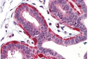 Human Breast (formalin-fixed, paraffin-embedded) stained with SNCG antibody ABIN364362 at 5 ug/ml followed by biotinylated goat anti-rabbit IgG secondary antibody ABIN481713, alkaline phosphatase-streptavidin and chromogen. (SNCG Antikörper)
