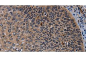 Immunohistochemistry of paraffin-embedded Human cervical cancer using P2RX2 Polyclonal Antibody at dilution of 1:50 (P2RX2 Antikörper)