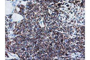 Immunohistochemical staining of paraffin-embedded Adenocarcinoma of Human breast tissue using anti-ALDH3A2 mouse monoclonal antibody. (ALDH3A2 Antikörper)