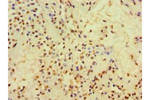Immunohistochemistry of paraffin-embedded human breast cancer using ABIN7148384 at dilution of 1:100 (Adipsin Antikörper  (AA 26-253))