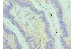 Immunohistochemistry of paraffin-embedded human colon cancer using ABIN7160711 at dilution of 1:100 (ASMTL Antikörper  (AA 1-290))
