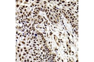 Immunohistochemistry of paraffin-embedded human well-differentiated squamous skin carcinoma using HIRIP3 antibody (ABIN6128019, ABIN6141779, ABIN6141780 and ABIN6222788) at dilution of 1:100 (40x lens). (HIRIP3 Antikörper  (AA 417-556))