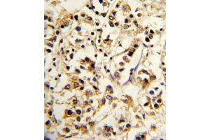 Formalin-fixed and paraffin-embedded human breast carcinoma reacted with KIR2DL4 Antibody (C-term), which was peroxidase-conjugated to the secondary antibody, followed by DAB staining.