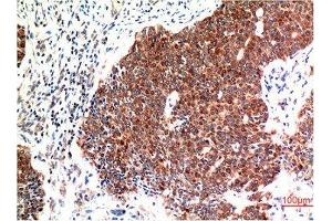 Immunohistochemical analysis of paraffin-embedded Human Breast Carcinoma Tissue using Beclin-1 Mouse mAb diluted at 1:200. (Beclin 1 Antikörper)
