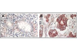 AP22624PU-N AKT antibody staining of Formalin-Fixed Paraffin-Embedded Sections at 1/1,000 dilution: Panel A: Normal colon tissue Panel B: Tumor tissue. (AKT1 Antikörper  (C-Term))