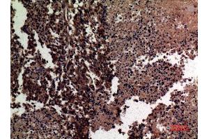 Immunohistochemistry (IHC) analysis of paraffin-embedded Human Lung Cancer, antibody was diluted at 1:100. (MMP12 Antikörper  (Internal Region))