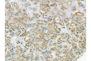 ABIN6265851 and ABIN6278192 at 1/100 staining human renal cell carcinoma by IHC-P. (UBE2L6 Antikörper  (C-Term))