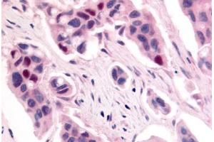 Anti-CDK12 / CRKRS antibody  ABIN1048422 IHC staining of human breast carcinoma. (CDK12 Antikörper  (Internal Region))