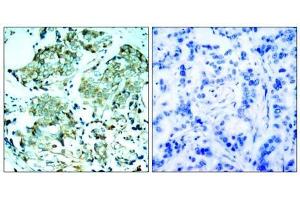 Immunohistochemical analysis of paraffin-embedded human breast carcinoma tissue, using (EGFR Antikörper)