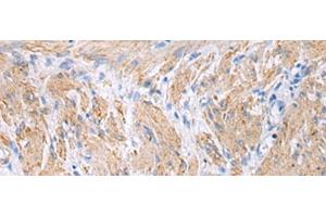 Immunohistochemistry of paraffin-embedded Human gastric cancer tissue using FBXO45 Polyclonal Antibody at dilution of 1:40(x200)
