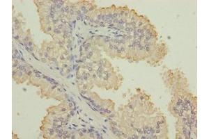 Immunohistochemistry of paraffin-embedded human prostate cancer using ABIN7157360 at dilution of 1:100 (Keratin 33B Antikörper  (AA 1-404))