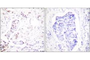 Immunohistochemistry analysis of paraffin-embedded human breast carcinoma tissue, using Cyclin A1 Antibody.