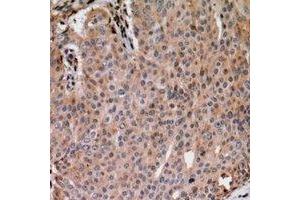 Immunohistochemical analysis of ANAPC1 (pS688) staining in human breast cancer formalin fixed paraffin embedded tissue section.