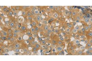 Immunohistochemistry of paraffin-embedded Human breast cancer using PLPP1 Polyclonal Antibody at dilution of 1:40 (PLPP1 Antikörper)