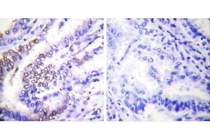 Peptide - +Immunohistochemical analysis of paraffin-embedded human lung carcinoma tissue using Cyclinantibody. (Cyclin E1 Antikörper)