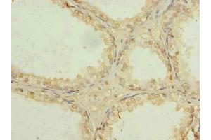 Immunohistochemistry of paraffin-embedded human prostate cancer using ABIN7174340 at dilution of 1:100