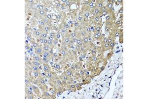 Immunohistochemistry of paraffin-embedded human colon carcinoma using PPOX antibody at dilution of 1:100 (x40 lens). (PPOX Antikörper)