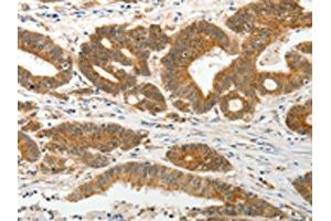 The image on the left is immunohistochemistry of paraffin-embedded Human colon cancer tissue using ABIN7131078(SLC12A1 Antibody) at dilution 1/15, on the right is treated with fusion protein.