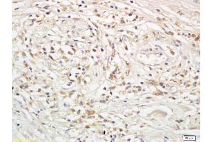 Formalin-fixed and paraffin embedded human rectal cancer labeled with Anti-Snail/SNAI 1 Polyclonal Antibody, Unconjugated (ABIN685597) followed by conjugation to the secondary antibody and DAB staining (SNAI1, SNAI2, SNAI3 (AA 188-264) Antikörper)