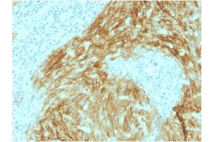 Formalin-fixed, paraffin-embedded human Follicular Dendritic Cell Sarcoma stained with CD21 / CR2 Mouse Monoclonal Antibody (CR2/1952). (CD21 Antikörper  (AA 44-196))